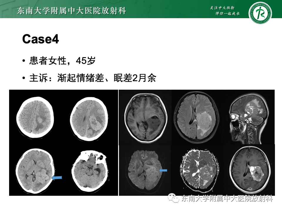 影像PPT - 【PPT】中枢神经细胞瘤-34 影像PPT - 【PPT】中枢神经细胞瘤-34