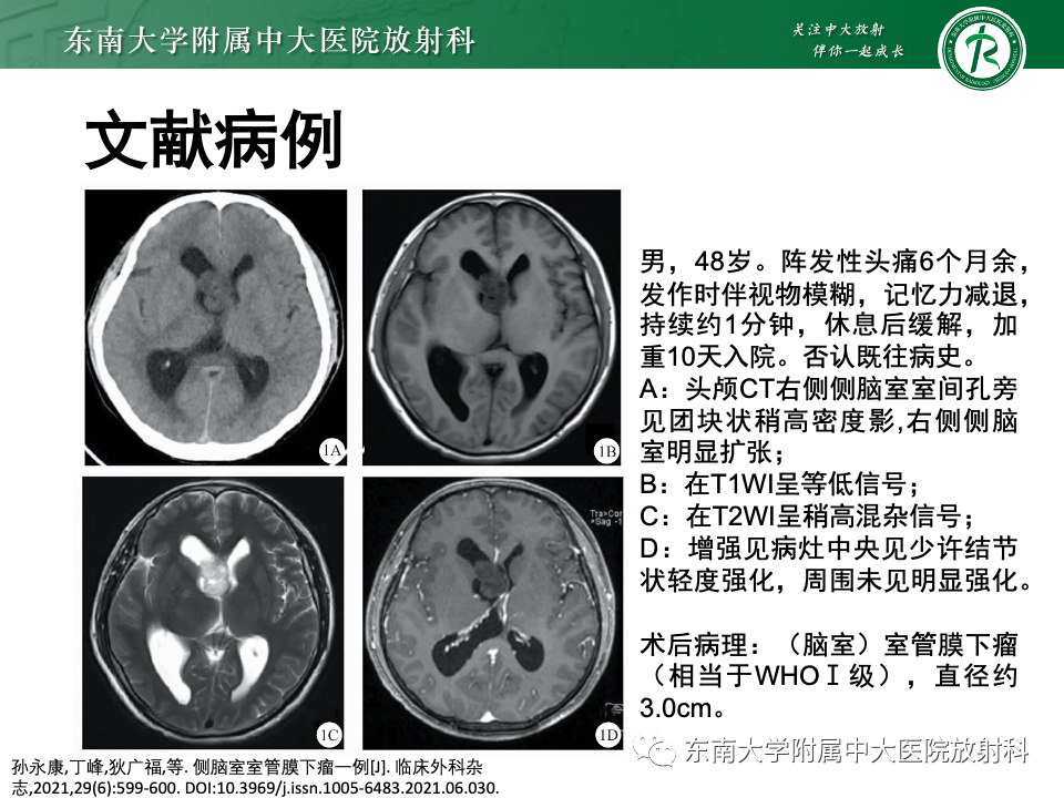 影像PPT - 【PPT】中枢神经细胞瘤-22 影像PPT - 【PPT】中枢神经细胞瘤-22
