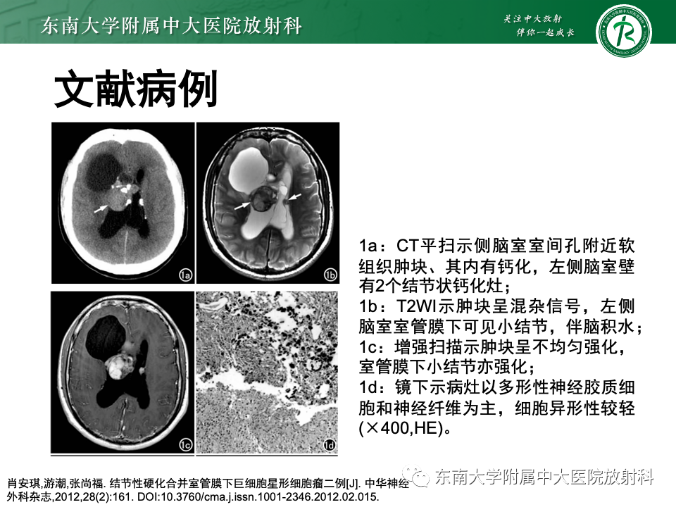 影像PPT - 【PPT】中枢神经细胞瘤-25 影像PPT - 【PPT】中枢神经细胞瘤-25