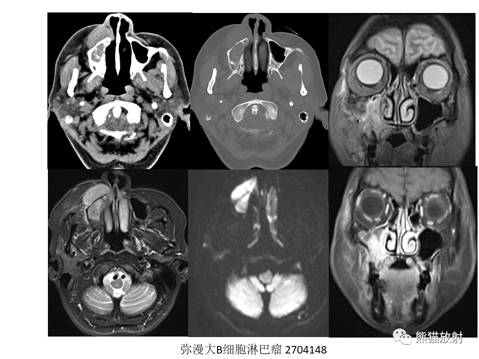 影像PPT - 【病例】鼻腔鼻窦淋巴瘤2例-22