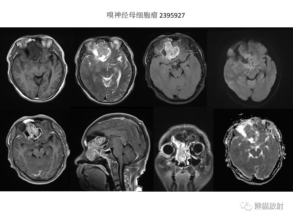 影像PPT - 【病例】鼻腔鼻窦淋巴瘤2例-27