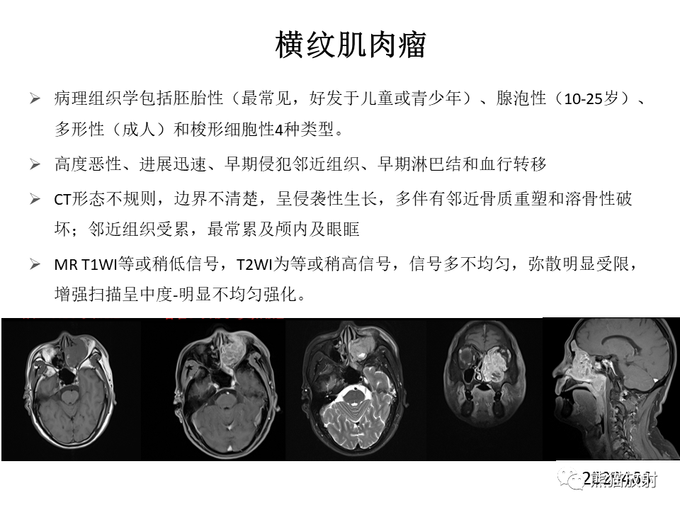 影像PPT - 【病例】鼻腔鼻窦淋巴瘤2例-28