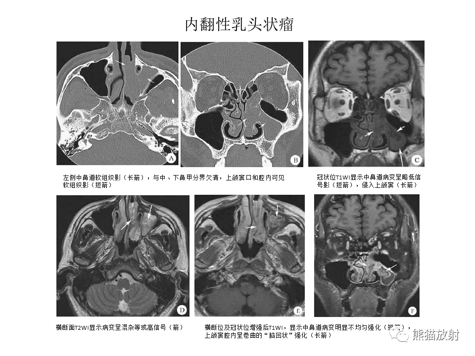 影像PPT - 【病例】鼻腔鼻窦淋巴瘤2例-30