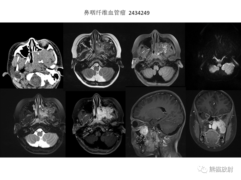 影像PPT - 【病例】鼻腔鼻窦淋巴瘤2例-32