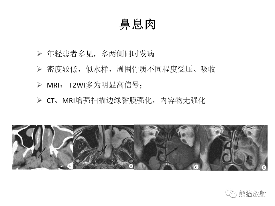 影像PPT - 【病例】鼻腔鼻窦淋巴瘤2例-33