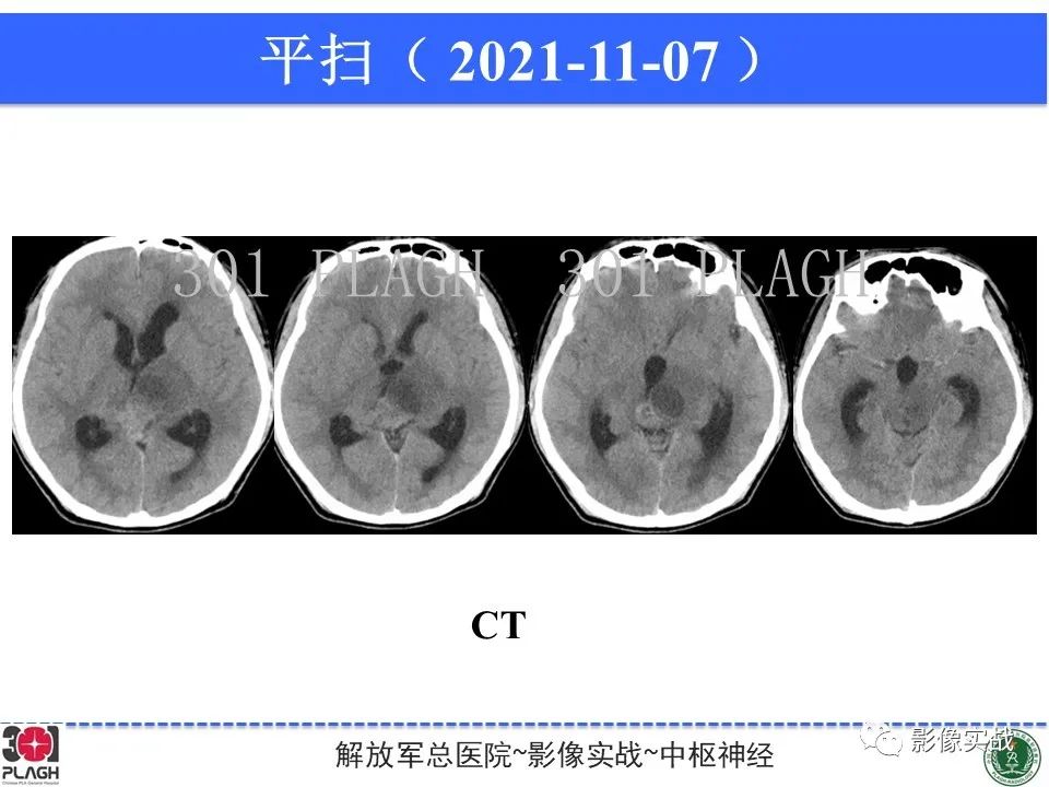 影像PPT - 【病例】松果体区乳头状瘤1例CT及MR-15