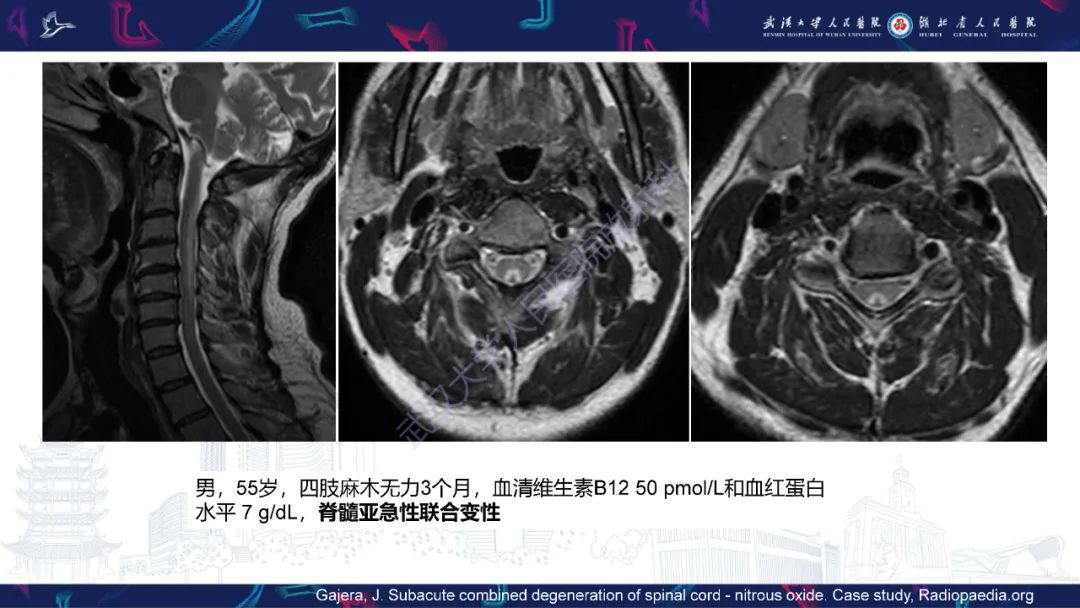 影像PPT - 【PPT】维生素B12缺乏神经影像诊断-20