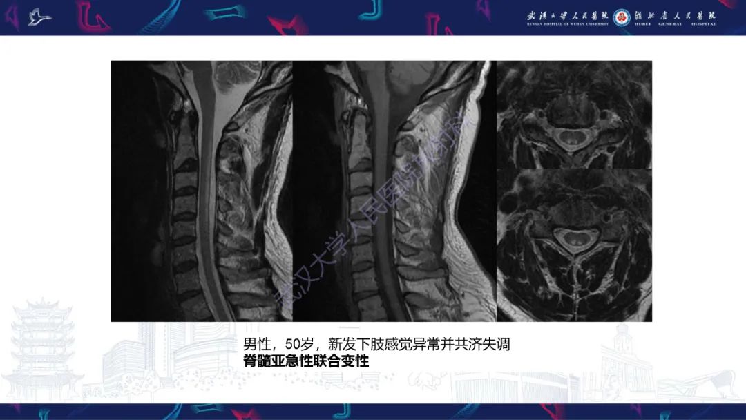 影像PPT - 【PPT】维生素B12缺乏神经影像诊断-22