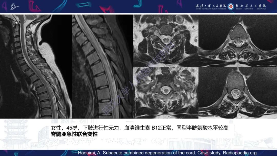 影像PPT - 【PPT】维生素B12缺乏神经影像诊断-23