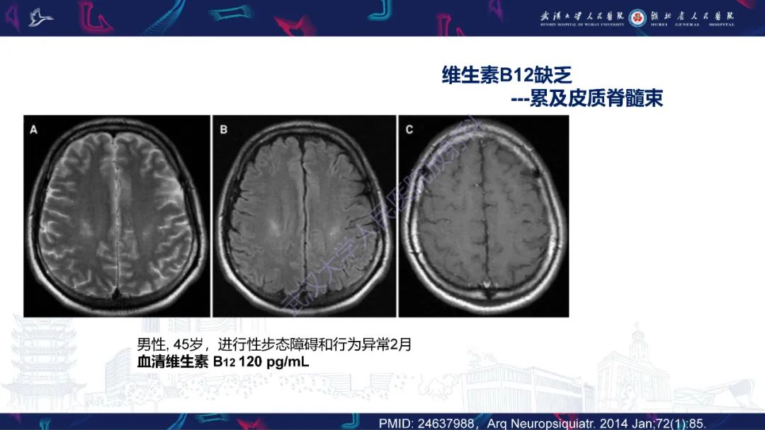影像PPT - 【PPT】维生素B12缺乏神经影像诊断-26