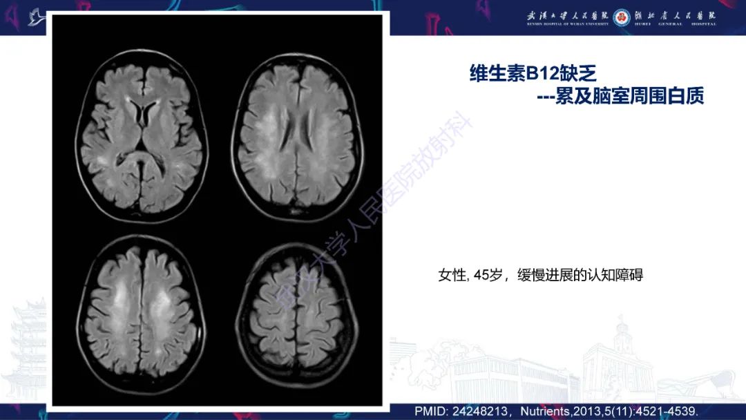 影像PPT - 【PPT】维生素B12缺乏神经影像诊断-25