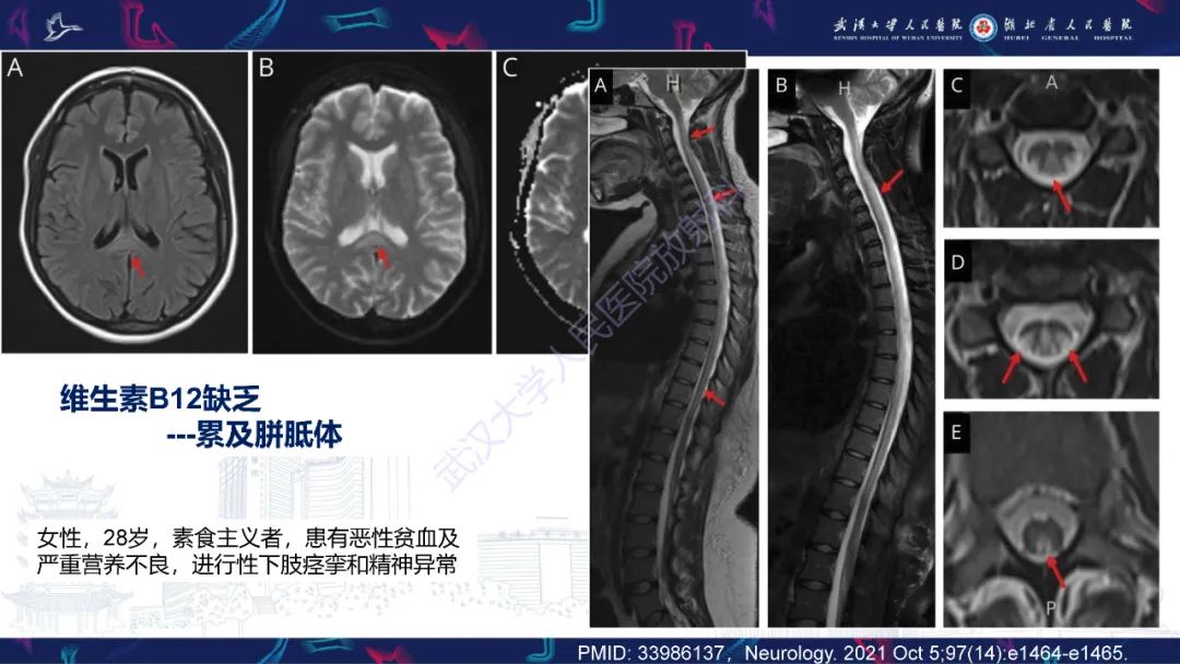 影像PPT - 【PPT】维生素B12缺乏神经影像诊断-27