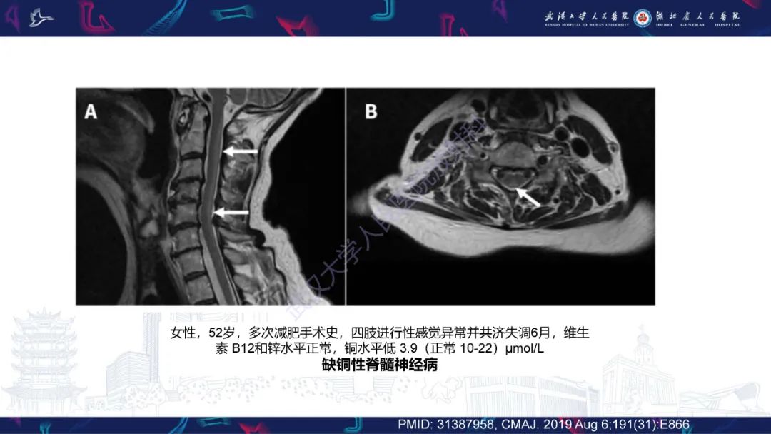 影像PPT - 【PPT】维生素B12缺乏神经影像诊断-31