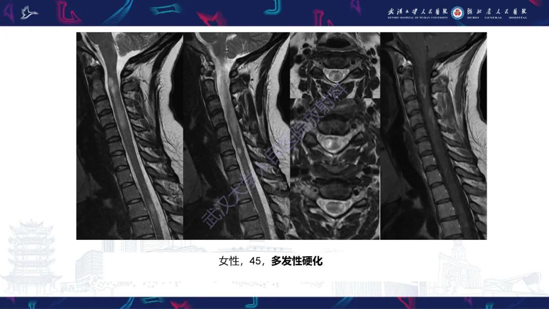影像PPT - 【PPT】维生素B12缺乏神经影像诊断-34
