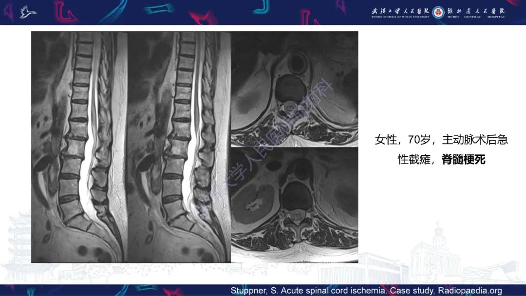 影像PPT - 【PPT】维生素B12缺乏神经影像诊断-44