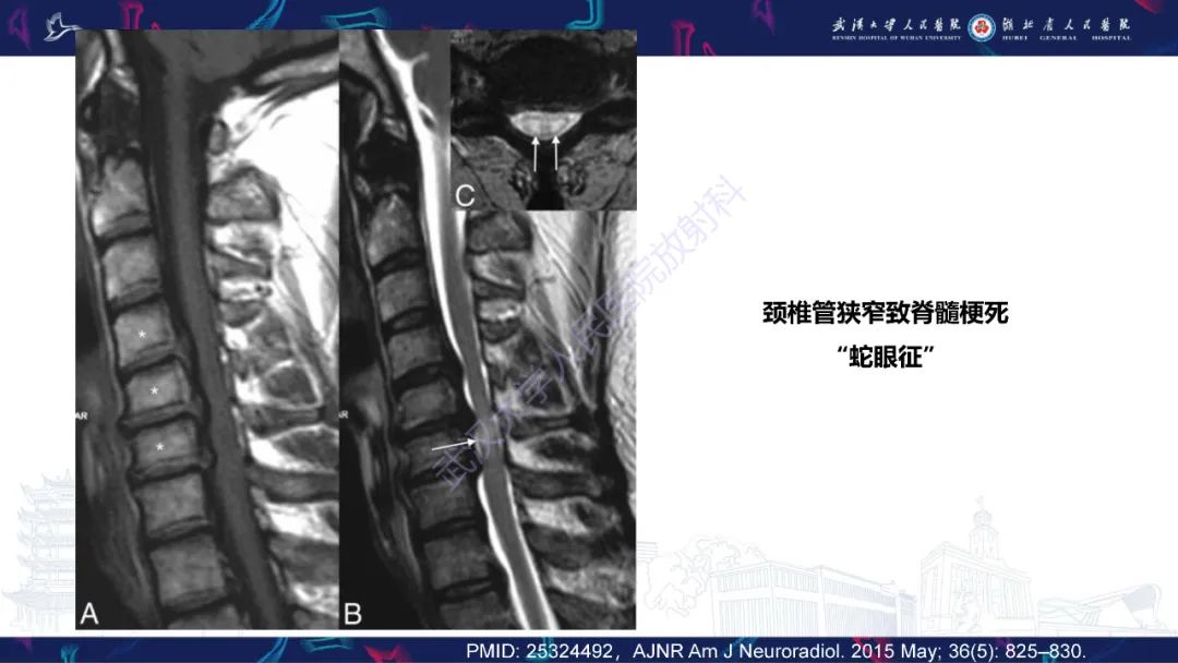 影像PPT - 【PPT】维生素B12缺乏神经影像诊断-45