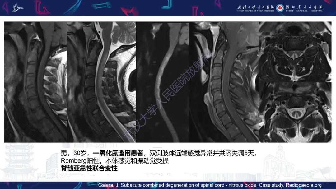 影像PPT - 【PPT】维生素B12缺乏神经影像诊断-21