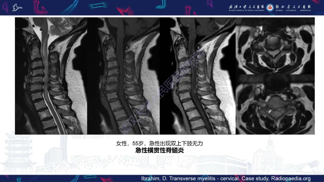影像PPT - 【PPT】维生素B12缺乏神经影像诊断-40