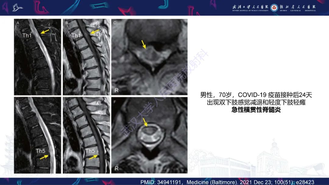 影像PPT - 【PPT】维生素B12缺乏神经影像诊断-3
