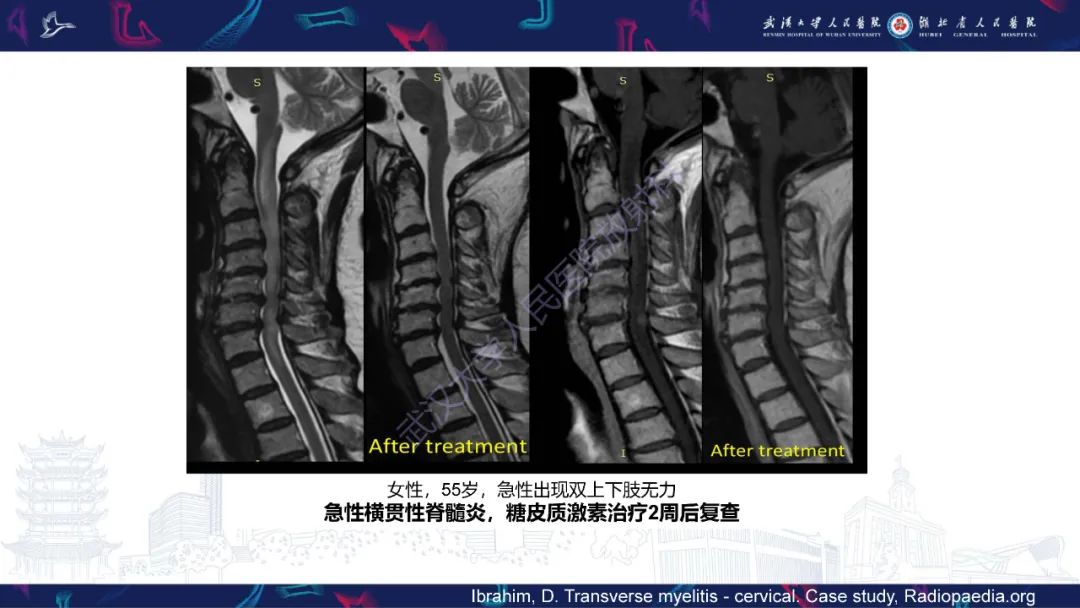 影像PPT - 【PPT】维生素B12缺乏神经影像诊断-4