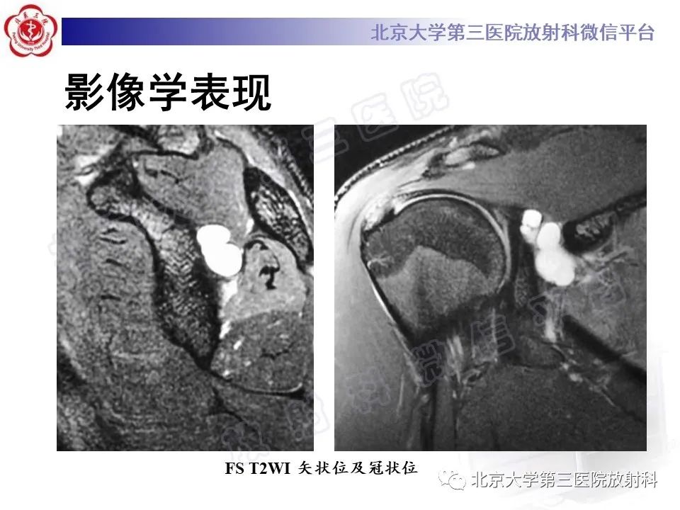 影像PPT - 【PPT】肩胛上神经卡压-3