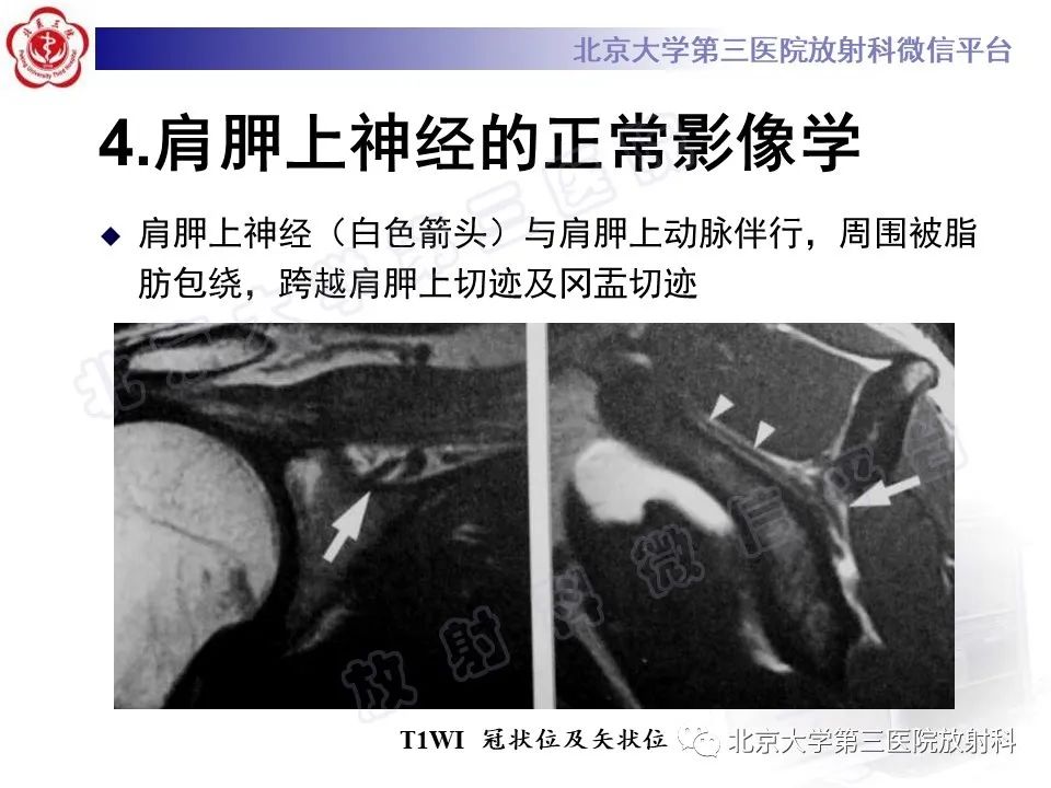 影像PPT - 【PPT】肩胛上神经卡压-10