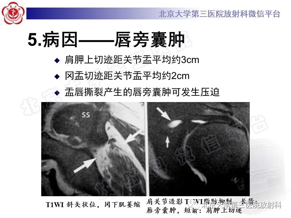 影像PPT - 【PPT】肩胛上神经卡压-13