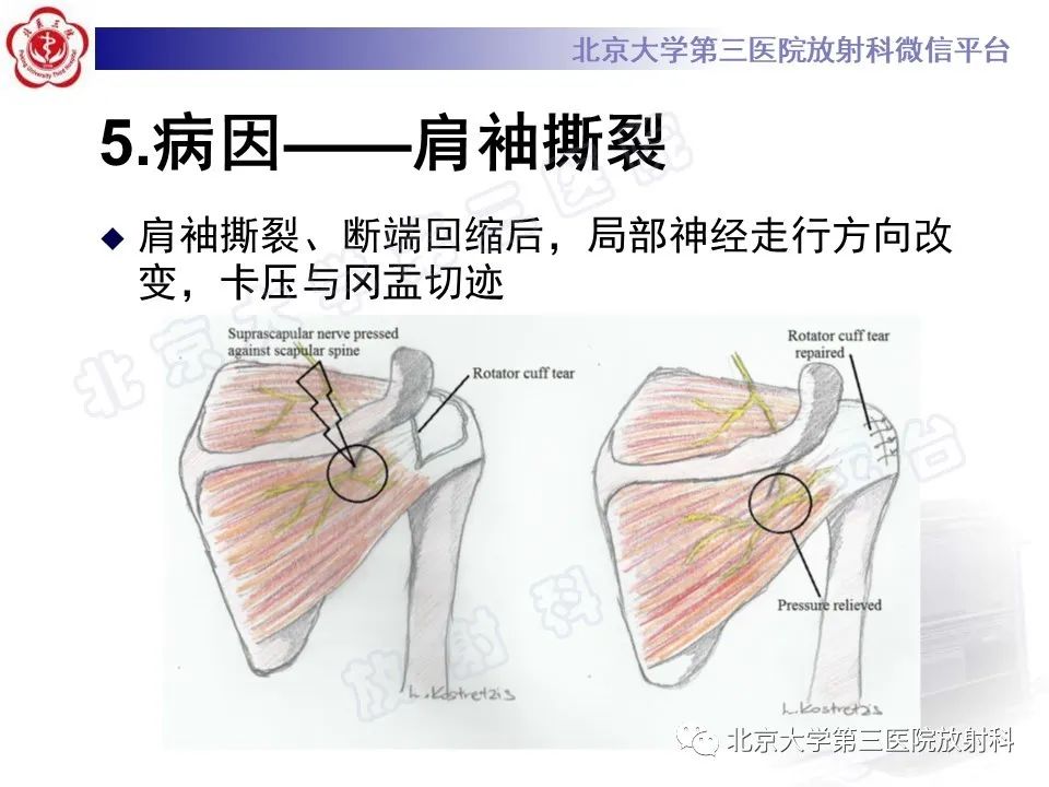 影像PPT - 【PPT】肩胛上神经卡压-14
