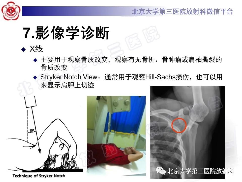 影像PPT - 【PPT】肩胛上神经卡压-17