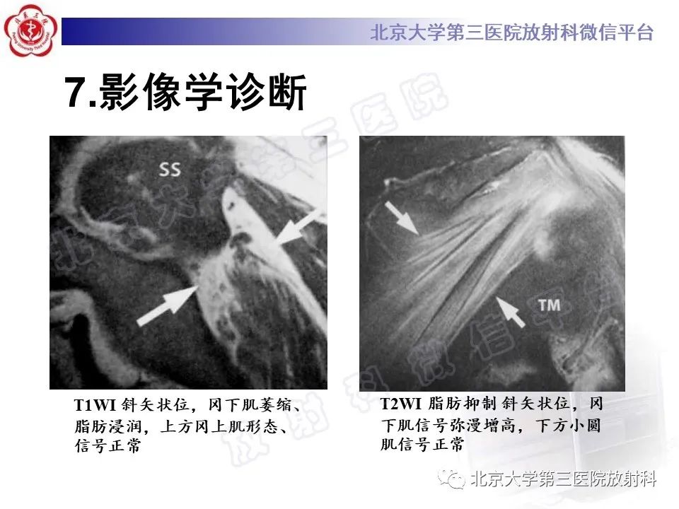 影像PPT - 【PPT】肩胛上神经卡压-20