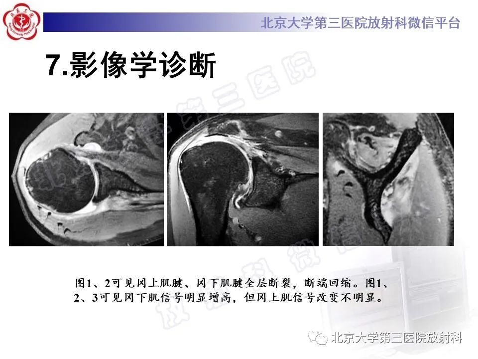 影像PPT - 【PPT】肩胛上神经卡压-23