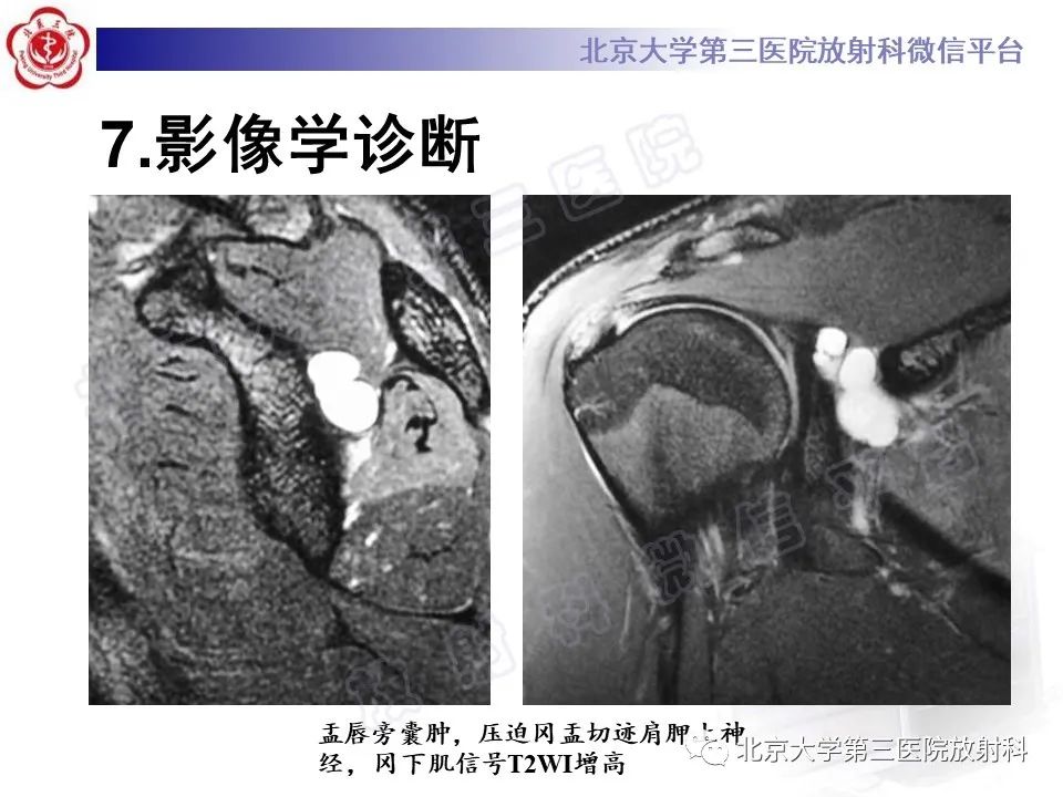 影像PPT - 【PPT】肩胛上神经卡压-22