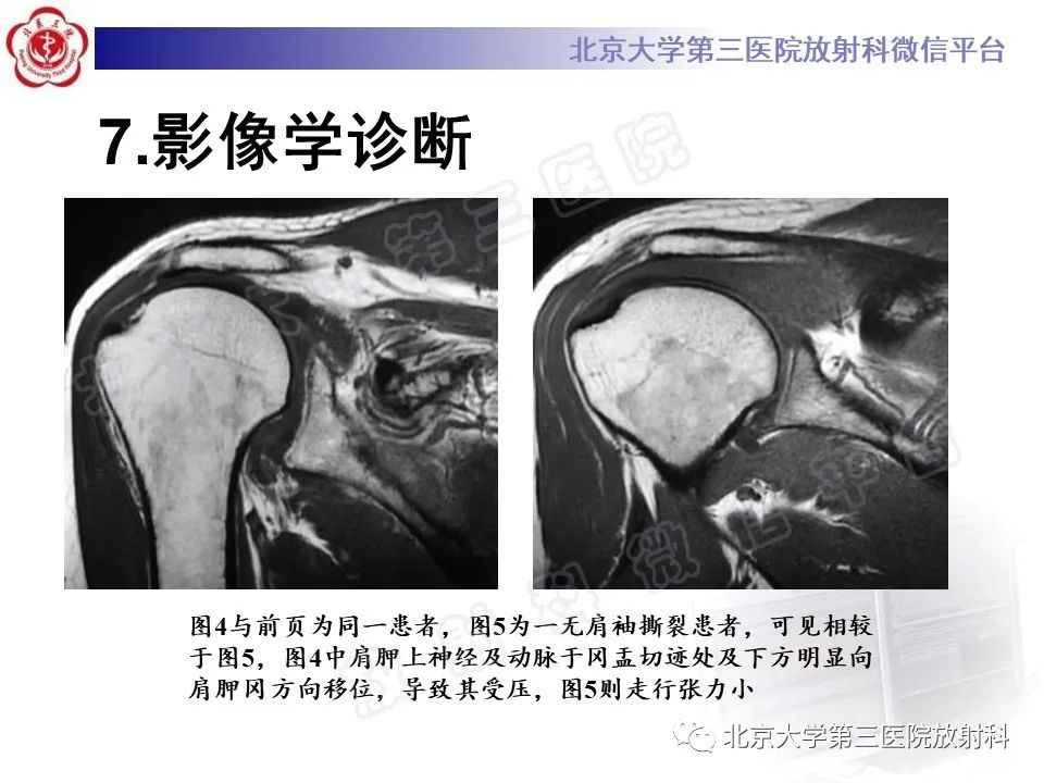 影像PPT - 【PPT】肩胛上神经卡压-24
