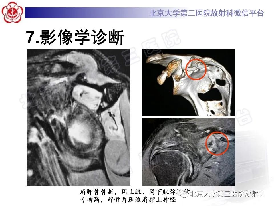 影像PPT - 【PPT】肩胛上神经卡压-25
