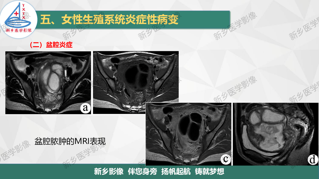 影像PPT - 【PPT】女性生殖炎症及子宫肌瘤影像表现-9