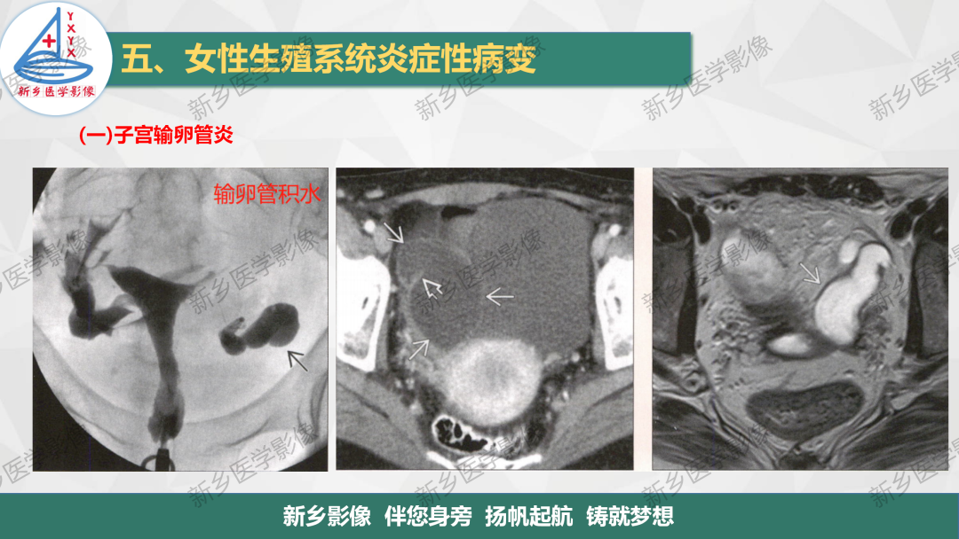 影像PPT - 【PPT】女性生殖炎症及子宫肌瘤影像表现-6