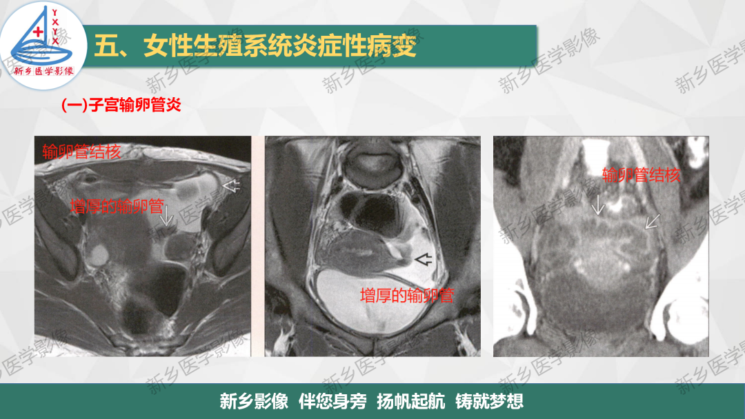 影像PPT - 【PPT】女性生殖炎症及子宫肌瘤影像表现-7