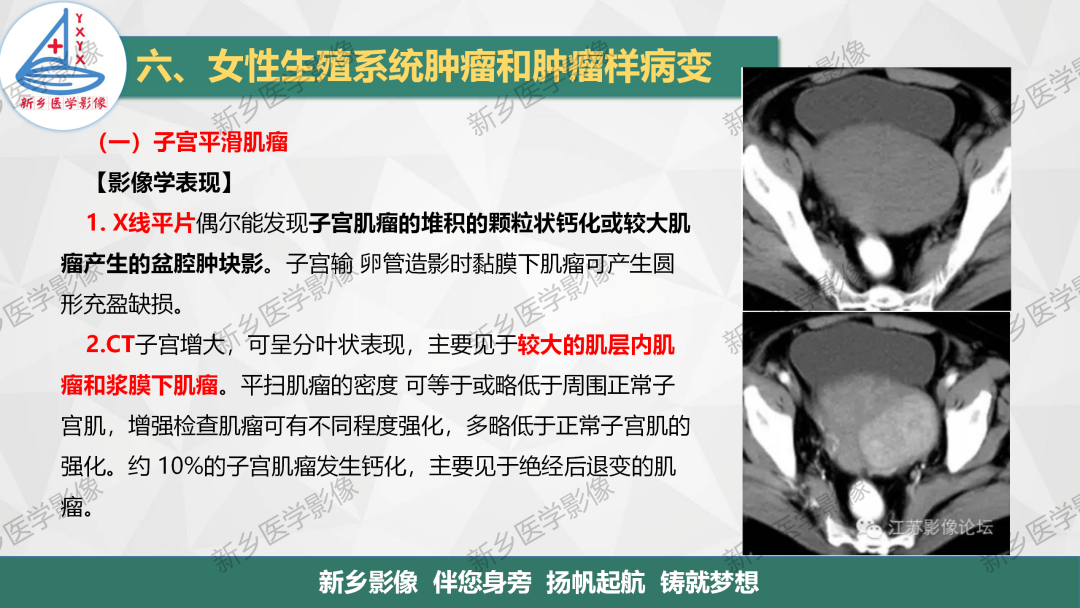 影像PPT - 【PPT】女性生殖炎症及子宫肌瘤影像表现-11