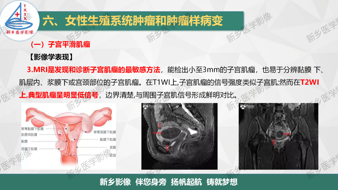 影像PPT - 【PPT】女性生殖炎症及子宫肌瘤影像表现-12