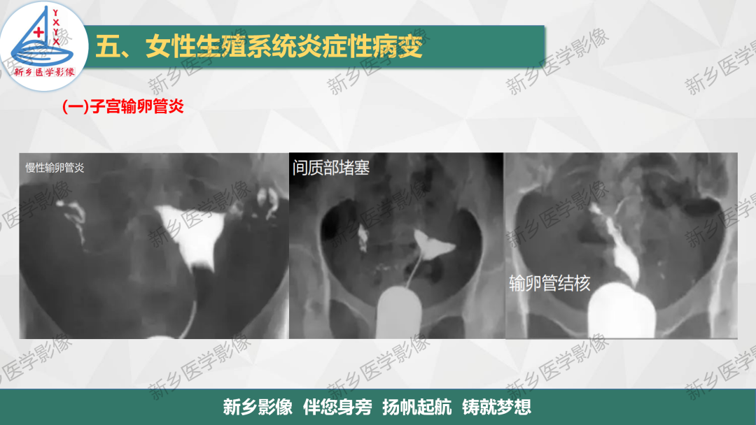 影像PPT - 【PPT】女性生殖炎症及子宫肌瘤影像表现-5