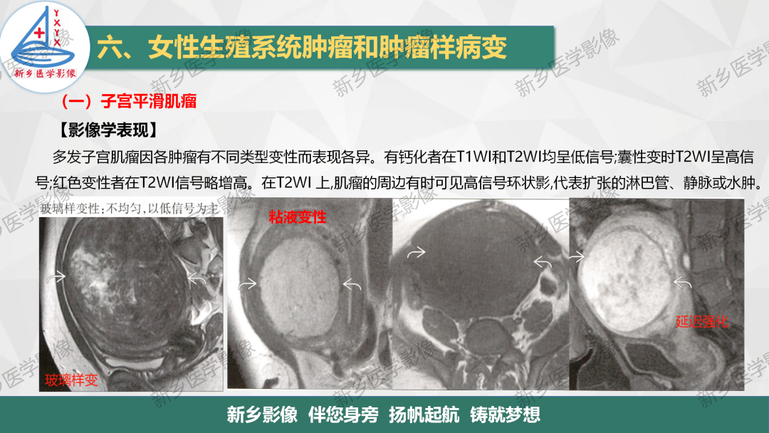 影像PPT - 【PPT】女性生殖炎症及子宫肌瘤影像表现-13