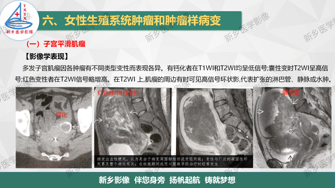 影像PPT - 【PPT】女性生殖炎症及子宫肌瘤影像表现-14
