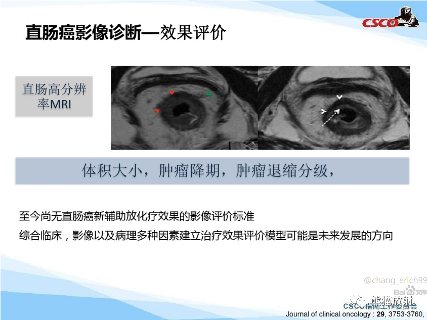 影像PPT - 直肠癌：MRI解剖、扫描规范、影像学评价、结构式报告-12