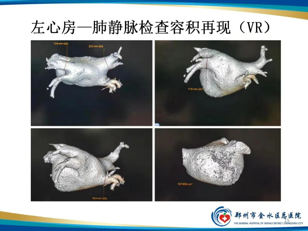 影像PPT - 【PPT】房颤术前的“排查兵”——左心房—肺静脉CTV检查-15