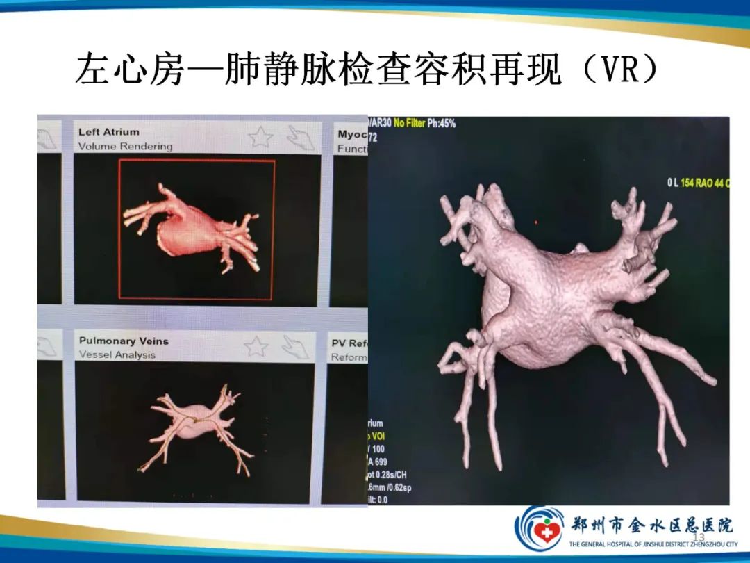 影像PPT - 【PPT】房颤术前的“排查兵”——左心房—肺静脉CTV检查-13
