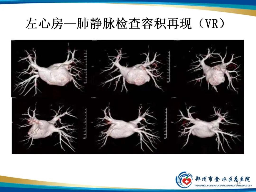 影像PPT - 【PPT】房颤术前的“排查兵”——左心房—肺静脉CTV检查-14