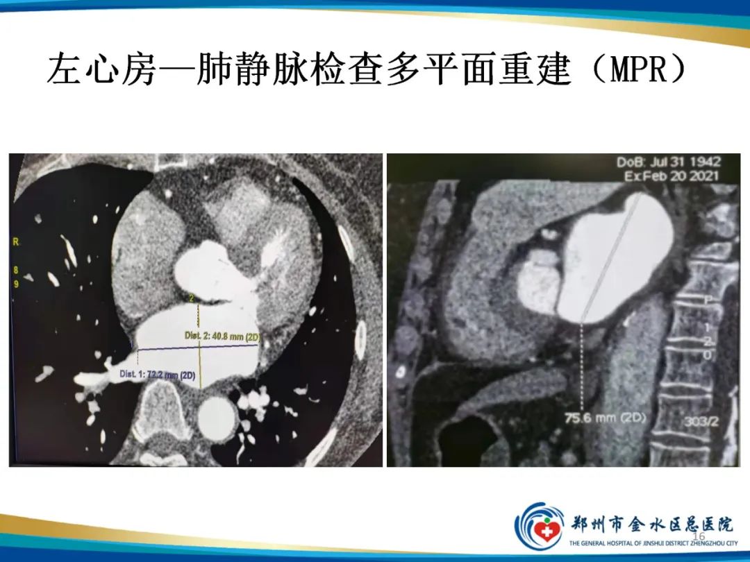 影像PPT - 【PPT】房颤术前的“排查兵”——左心房—肺静脉CTV检查-16