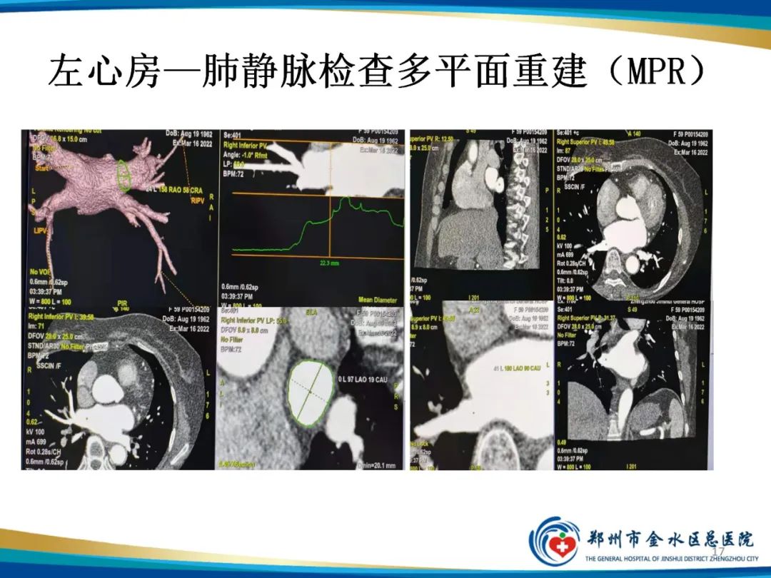 影像PPT - 【PPT】房颤术前的“排查兵”——左心房—肺静脉CTV检查-17