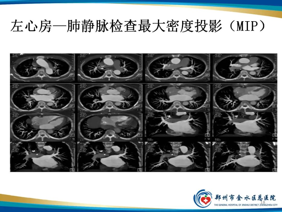 影像PPT - 【PPT】房颤术前的“排查兵”——左心房—肺静脉CTV检查-18