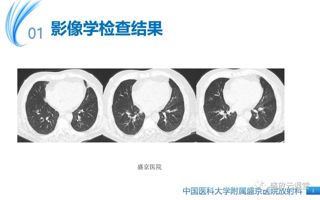 影像PPT - 【病例】弥漫性气管狭窄1例CT影像-2
